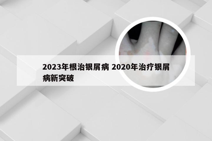 2023年根治银屑病 2020年治疗银屑病新突破