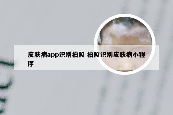 皮肤病app识别拍照 拍照识别皮肤病小程序