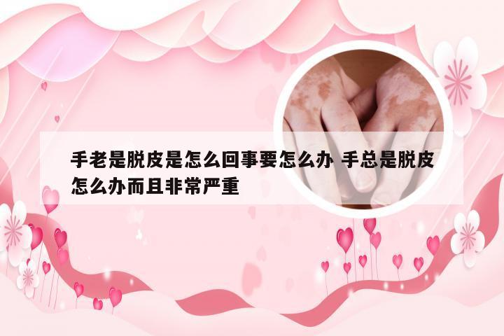 手老是脱皮是怎么回事要怎么办 手总是脱皮怎么办而且非常严重