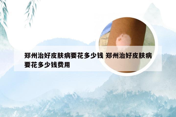 郑州治好皮肤病要花多少钱 郑州治好皮肤病要花多少钱费用