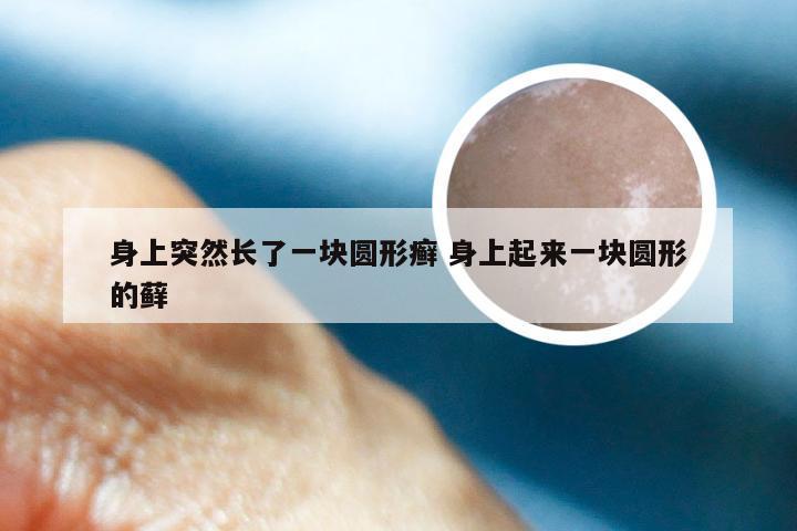 身上突然长了一块圆形癣 身上起来一块圆形的藓