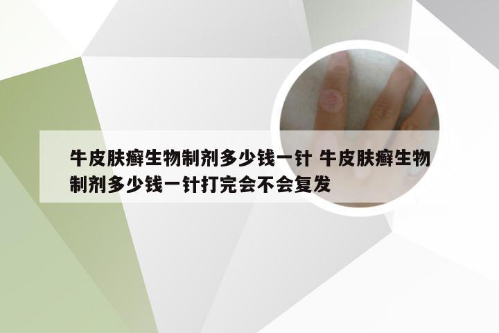 牛皮肤癣生物制剂多少钱一针 牛皮肤癣生物制剂多少钱一针打完会不会复发
