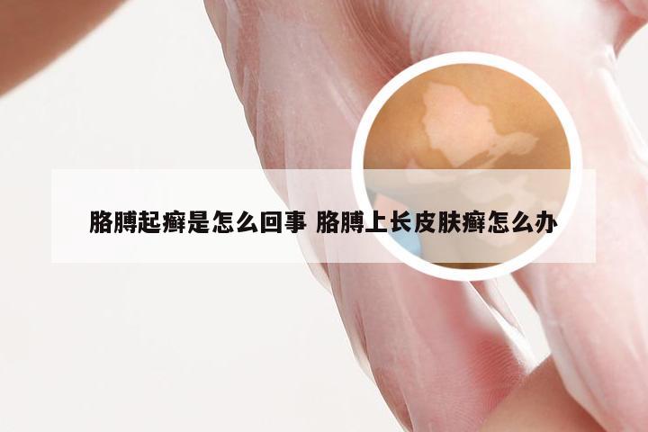 胳膊起癣是怎么回事 胳膊上长皮肤癣怎么办