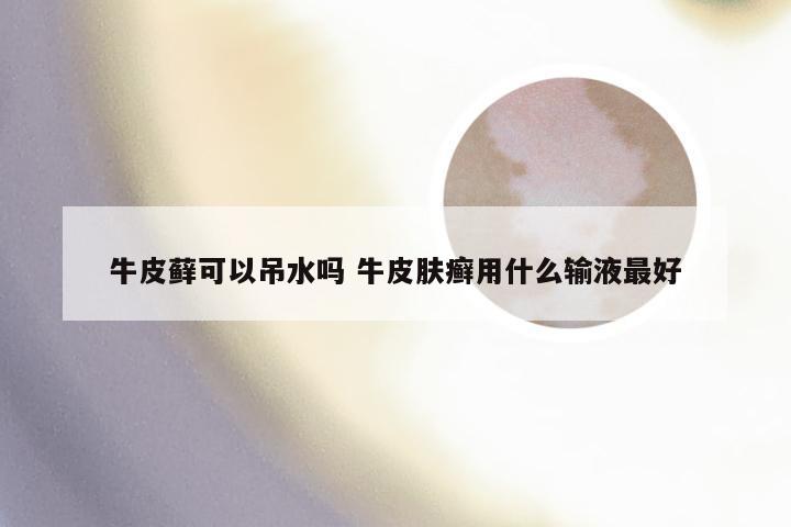 牛皮藓可以吊水吗 牛皮肤癣用什么输液最好