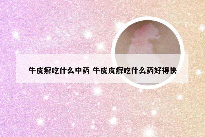 牛皮癣吃什么中药 牛皮皮癣吃什么药好得快