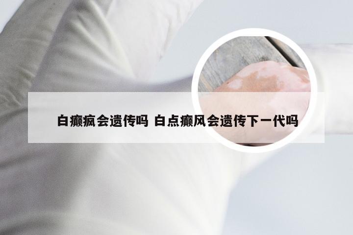 白癫疯会遗传吗 白点癫风会遗传下一代吗