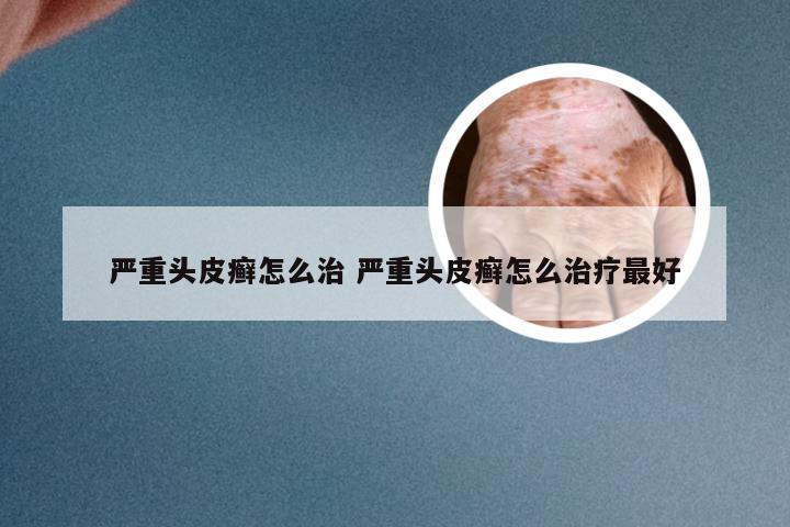 严重头皮癣怎么治 严重头皮癣怎么治疗最好