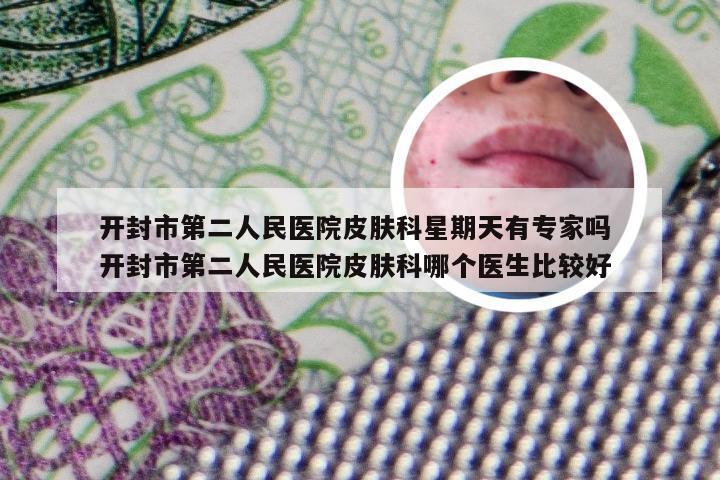 开封市第二人民医院皮肤科星期天有专家吗 开封市第二人民医院皮肤科哪个医生比较好