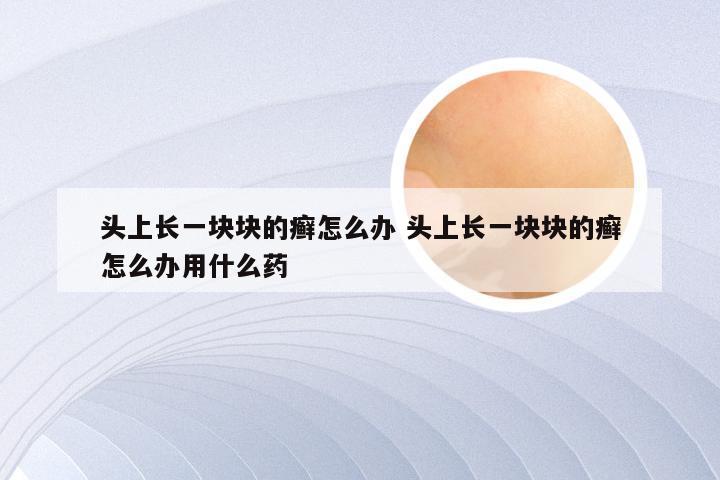 头上长一块块的癣怎么办 头上长一块块的癣怎么办用什么药
