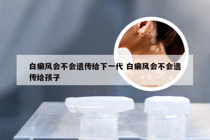 白癞风会不会遗传给下一代 白癞风会不会遗传给孩子