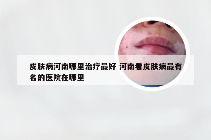 皮肤病河南哪里治疗最好 河南看皮肤病最有名的医院在哪里