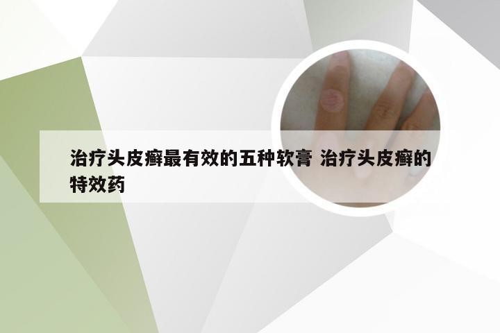 治疗头皮癣最有效的五种软膏 治疗头皮癣的特效药
