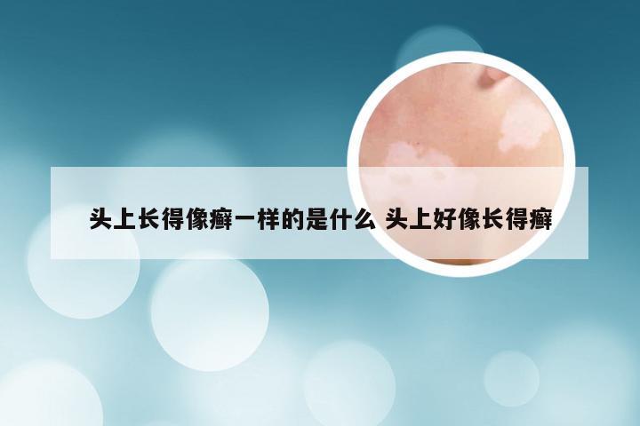 头上长得像癣一样的是什么 头上好像长得癣
