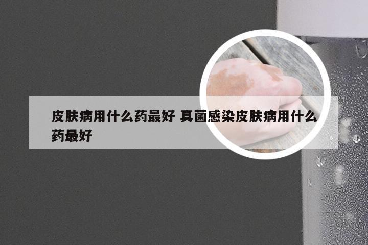 皮肤病用什么药最好 真菌感染皮肤病用什么药最好