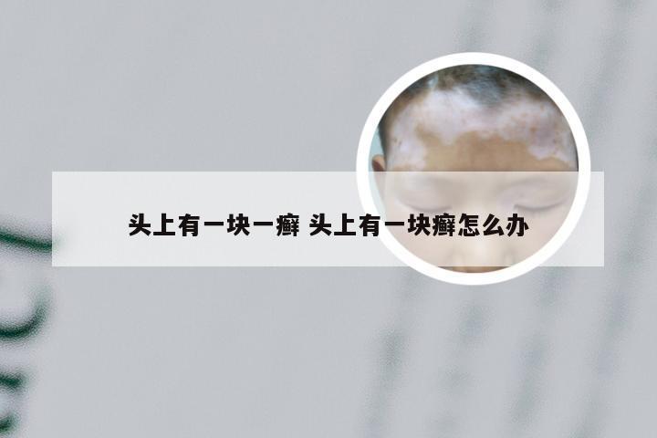 头上有一块一癣 头上有一块癣怎么办