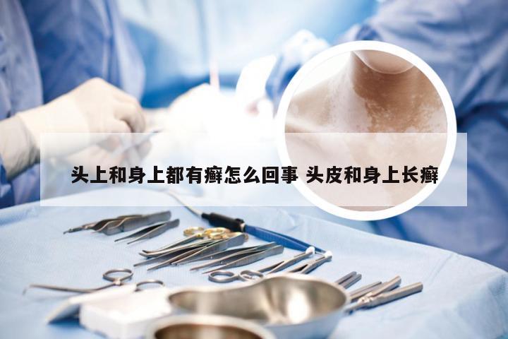 头上和身上都有癣怎么回事 头皮和身上长癣