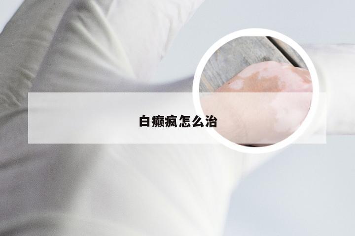 白癫疯怎么治
