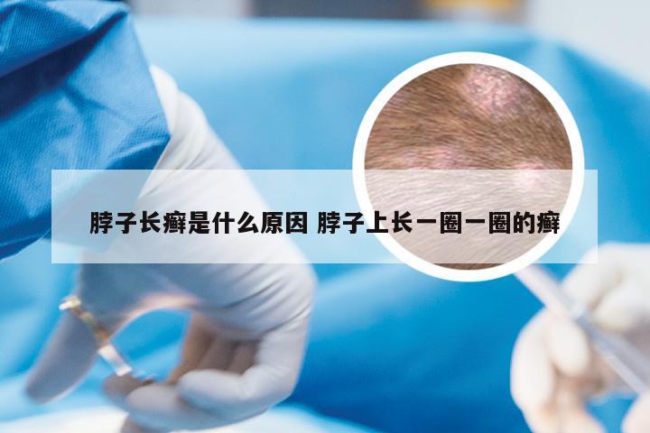脖子长癣是什么原因 脖子上长一圈一圈的癣