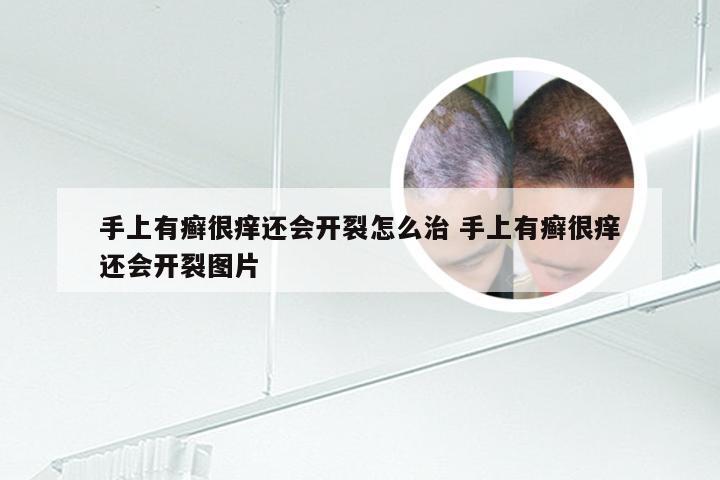 手上有癣很痒还会开裂怎么治 手上有癣很痒还会开裂图片