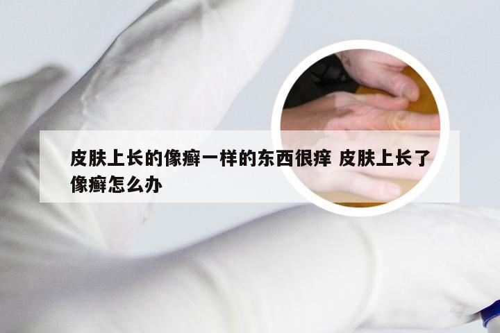 皮肤上长的像癣一样的东西很痒 皮肤上长了像癣怎么办