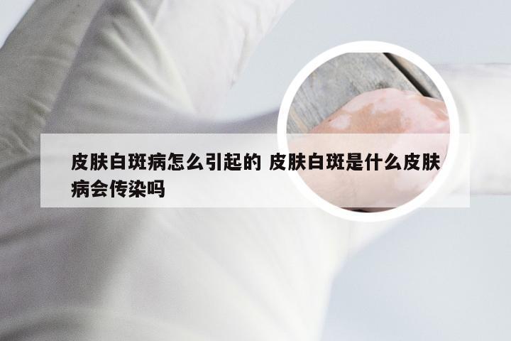 皮肤白斑病怎么引起的 皮肤白斑是什么皮肤病会传染吗