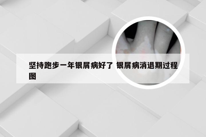 坚持跑步一年银屑病好了 银屑病消退期过程图