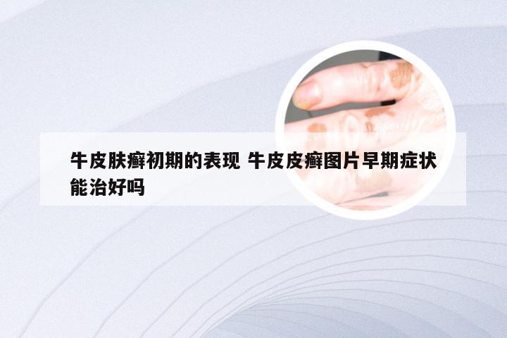 牛皮肤癣初期的表现 牛皮皮癣图片早期症状能治好吗