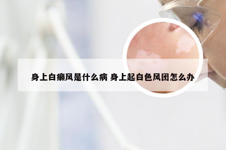 身上白癞风是什么病 身上起白色风团怎么办