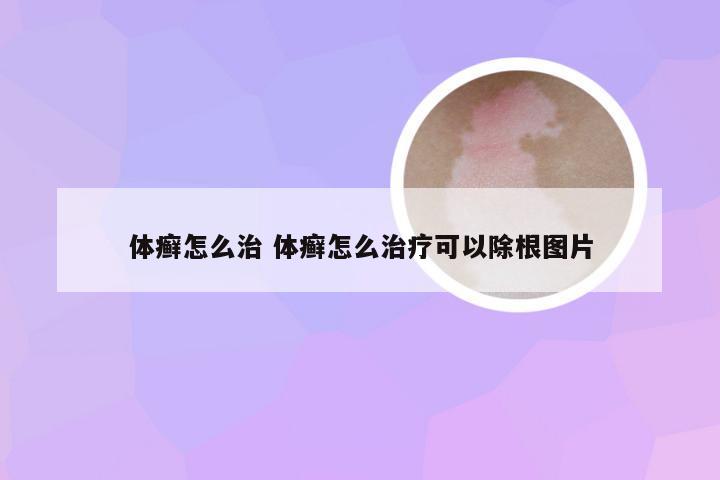 体癣怎么治 体癣怎么治疗可以除根图片