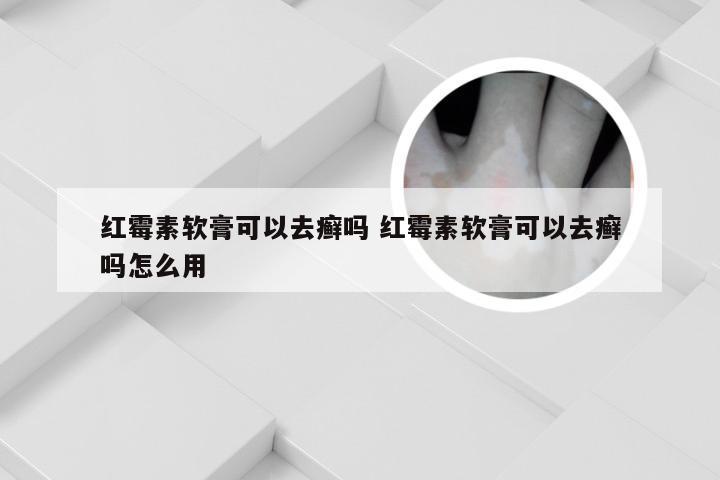 红霉素软膏可以去癣吗 红霉素软膏可以去癣吗怎么用