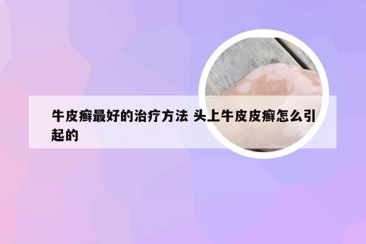 牛皮癣最好的治疗方法 头上牛皮皮癣怎么引起的