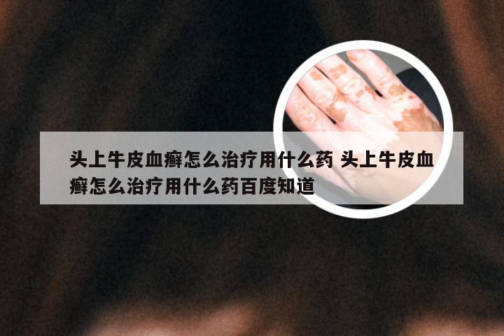 头上牛皮血癣怎么治疗用什么药 头上牛皮血癣怎么治疗用什么药百度知道