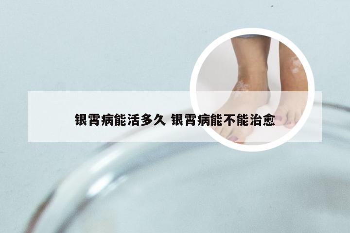 银霄病能活多久 银霄病能不能治愈