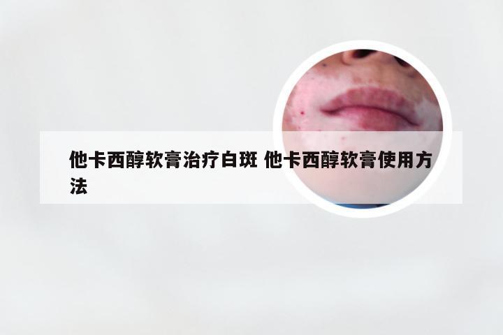 他卡西醇软膏治疗白斑 他卡西醇软膏使用方法