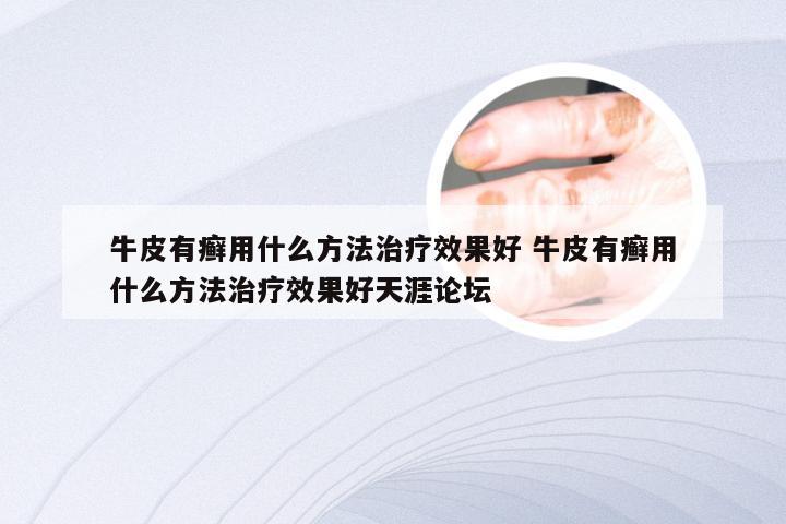 牛皮有癣用什么方法治疗效果好 牛皮有癣用什么方法治疗效果好天涯论坛