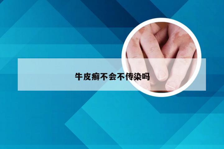牛皮癣不会不传染吗