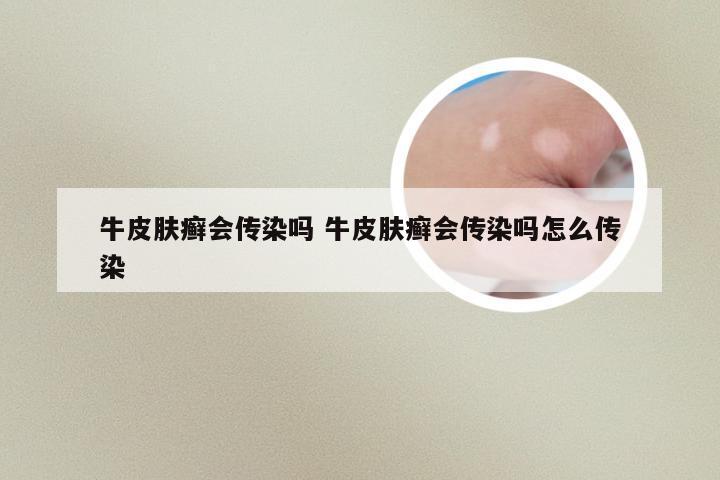 牛皮肤癣会传染吗 牛皮肤癣会传染吗怎么传染