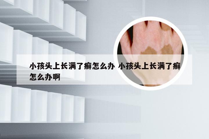 小孩头上长满了癣怎么办 小孩头上长满了癣怎么办啊