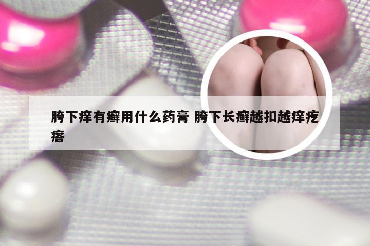 胯下痒有癣用什么药膏 胯下长癣越扣越痒疙瘩