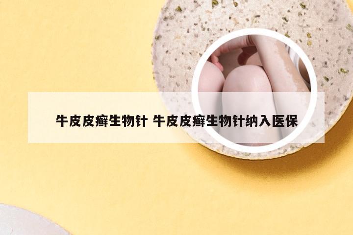 牛皮皮癣生物针 牛皮皮癣生物针纳入医保