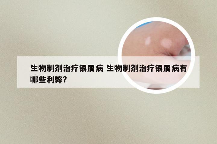 生物制剂治疗银屑病 生物制剂治疗银屑病有哪些利弊?