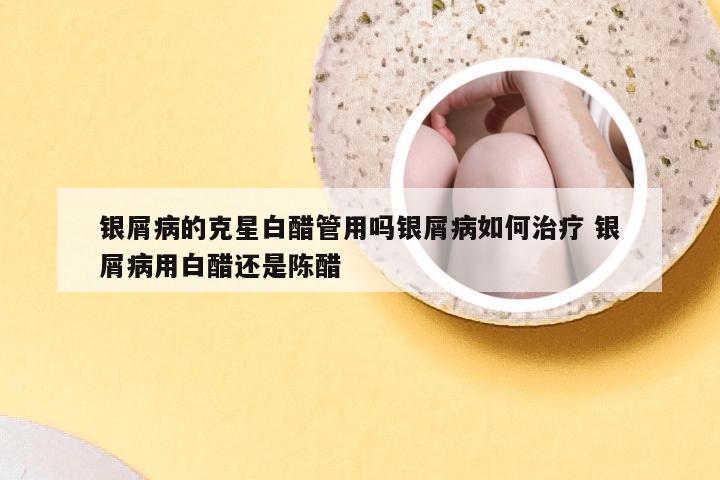 银屑病的克星白醋管用吗银屑病如何治疗 银屑病用白醋还是陈醋
