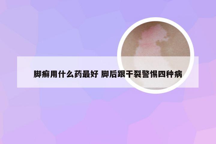 脚癣用什么药最好 脚后跟干裂警惕四种病