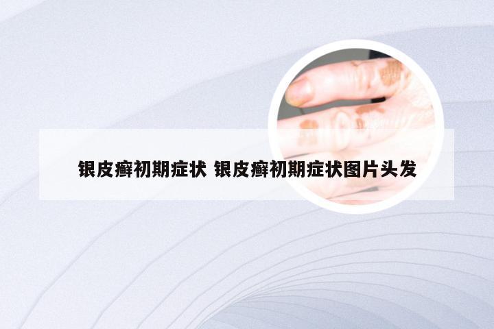 银皮癣初期症状 银皮癣初期症状图片头发