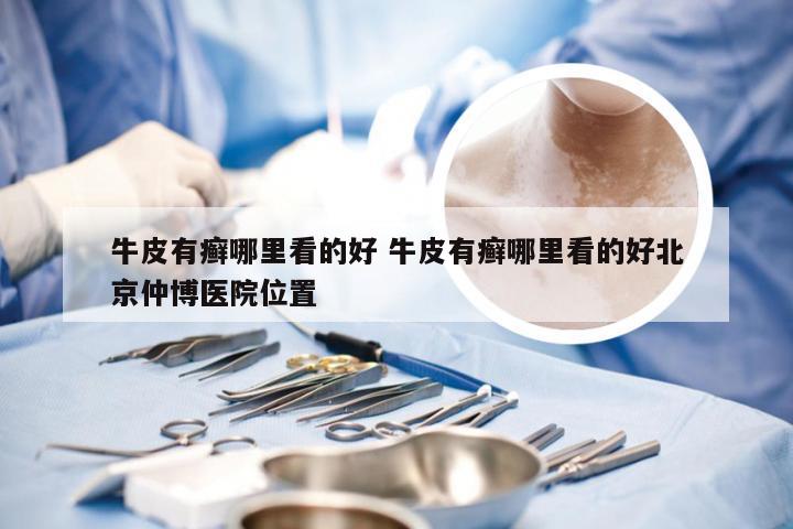 牛皮有癣哪里看的好 牛皮有癣哪里看的好北京仲博医院位置