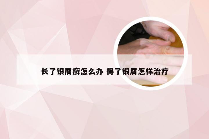 长了银屑癣怎么办 得了银屑怎样治疗