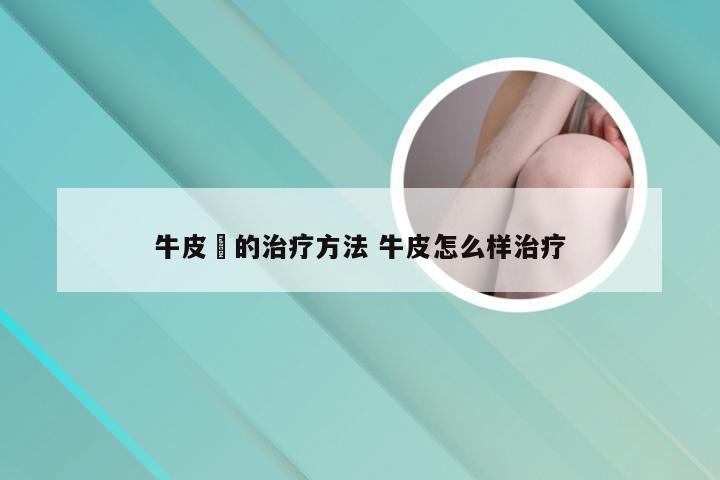 牛皮廯的治疗方法 牛皮怎么样治疗