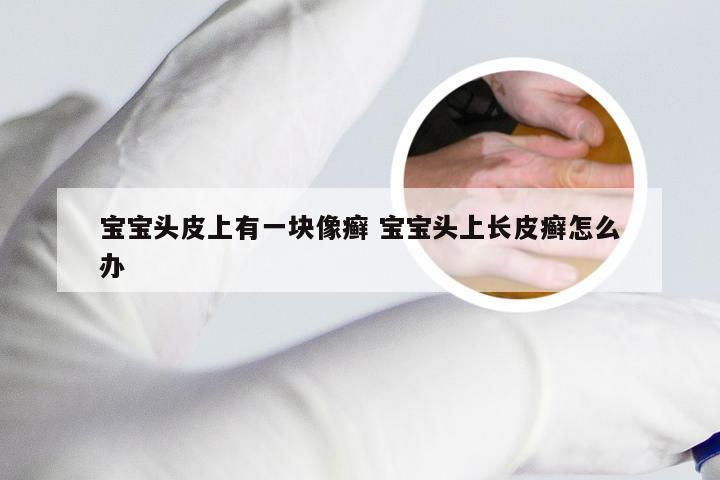 宝宝头皮上有一块像癣 宝宝头上长皮癣怎么办