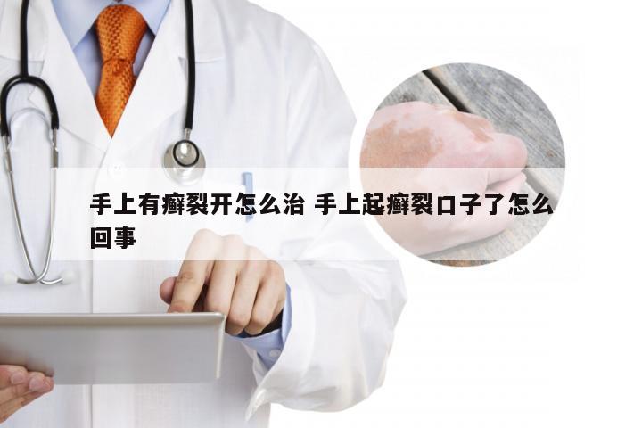 手上有癣裂开怎么治 手上起癣裂口子了怎么回事