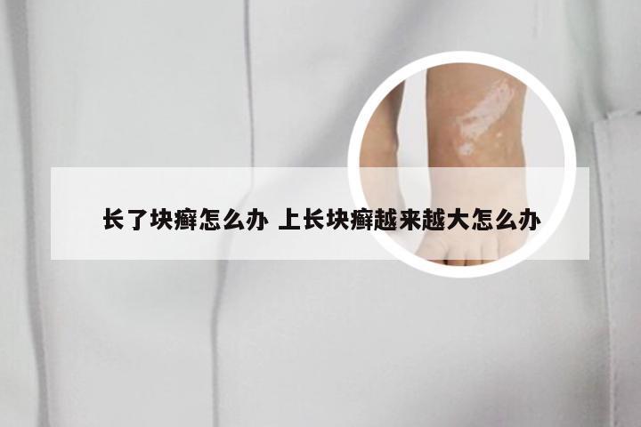 长了块癣怎么办 上长块癣越来越大怎么办